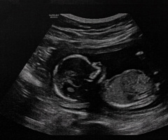 Woman sues abortionist for $250K over perforated uterus, dead baby's skull fragments in intestine