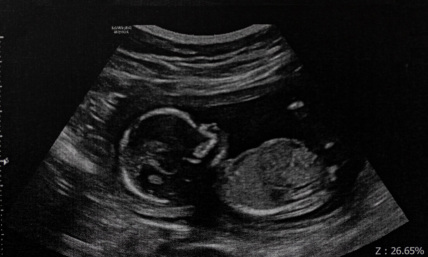Woman sues abortionist for $250K over perforated uterus, dead baby's skull fragments in intestine